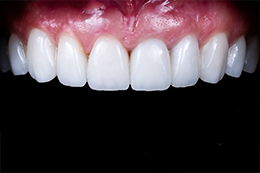 歯のセラミック治療でのe-max の適応について