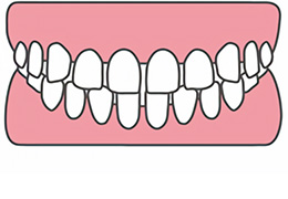 空隙歯列（くうげきしれつ）/すきっ歯