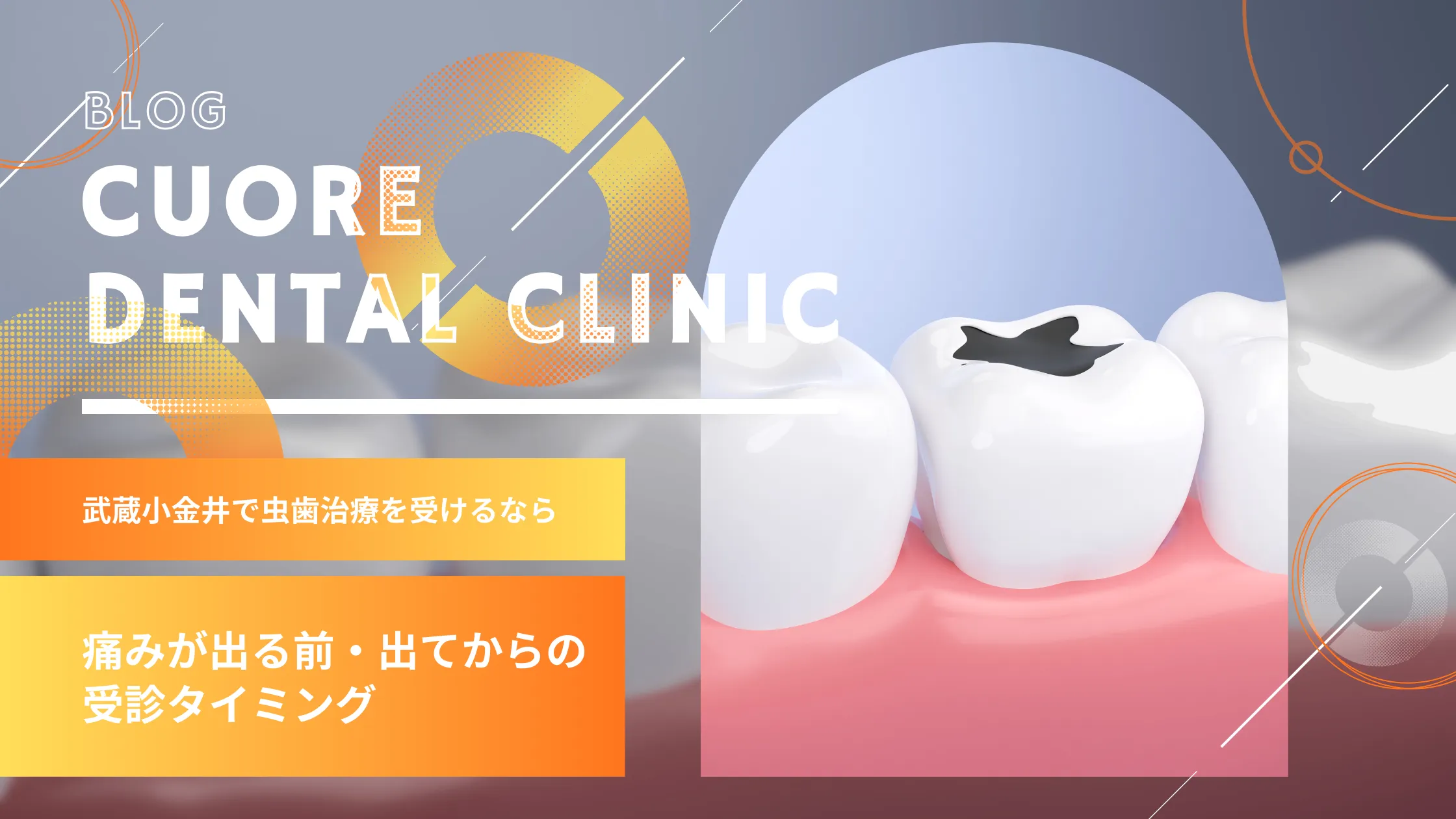 虫歯は「痛くなる前」が勝負？歯科医が教える受診のベストなタイミングと治療の考え方｜武蔵小金井駅徒歩2分の歯医者・歯科「クオーレ歯科クリニック」