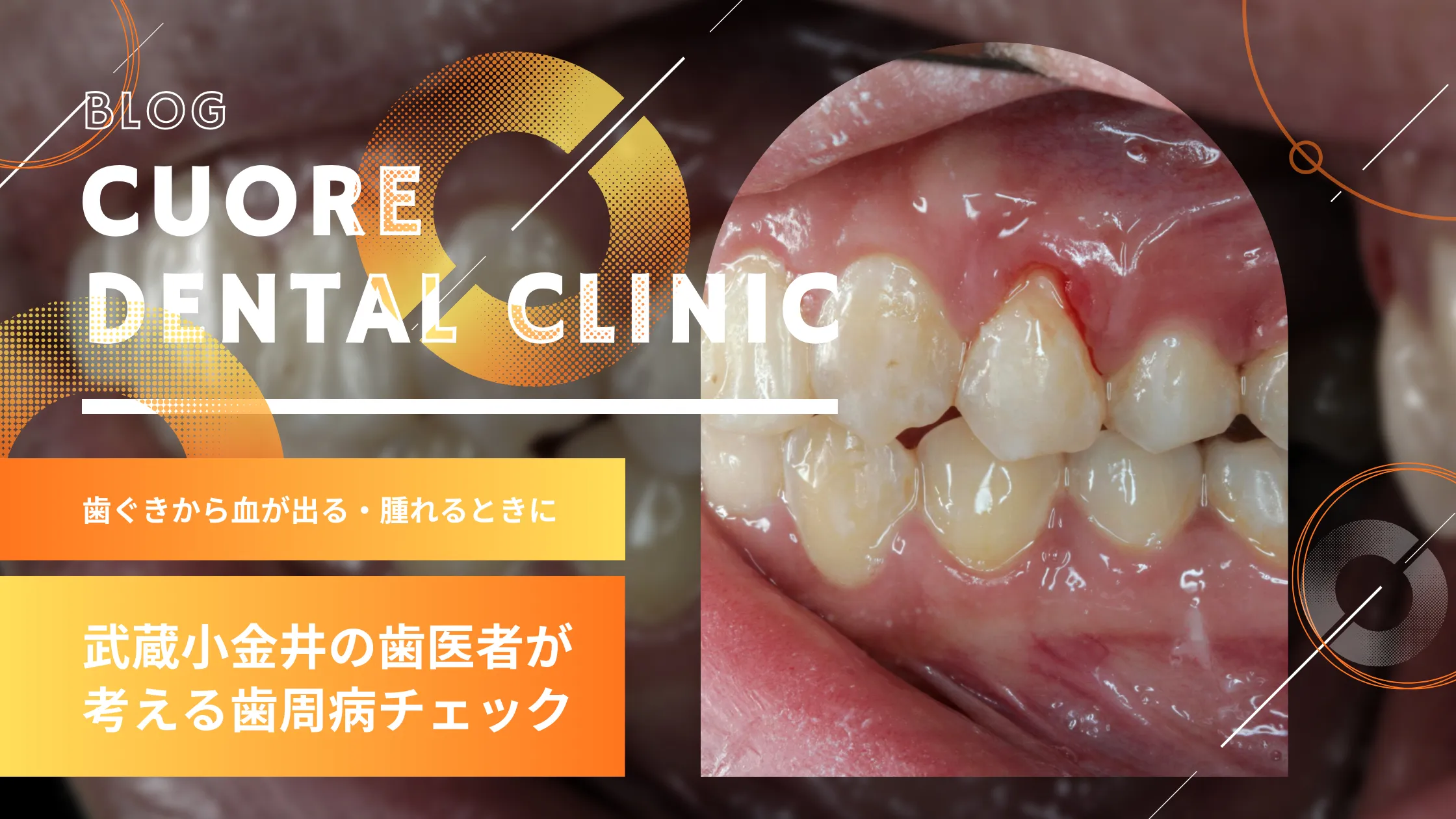 「歯ブラシに血がつく」は危険信号？歯周病のセルフチェックと歯科医が教える受診の目安｜武蔵小金井駅徒歩2分の歯医者・歯科「クオーレ歯科クリニック」
