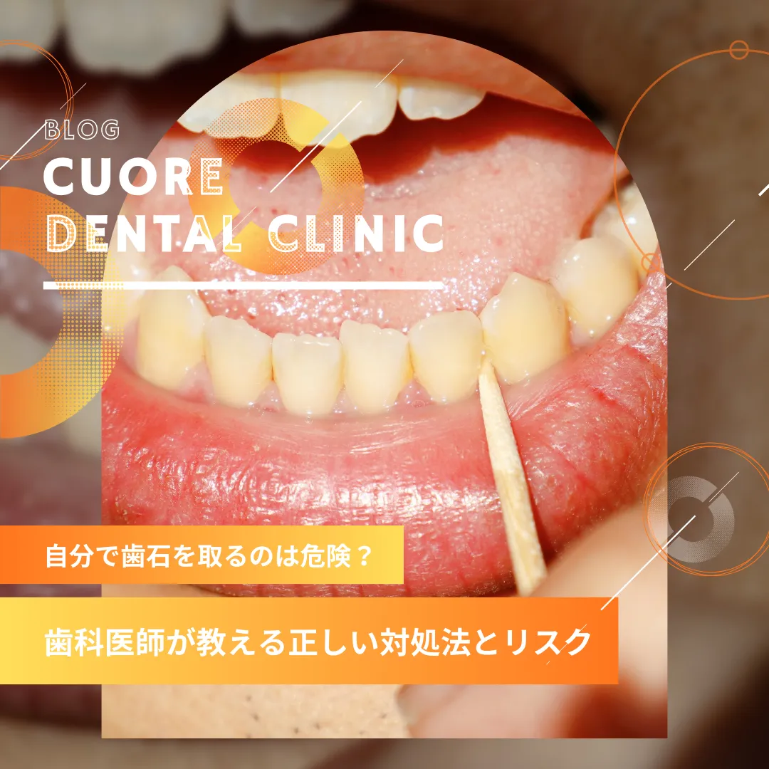 自分で歯石を取るのは危険？歯科医師が教える正しい対処法とリスク｜武蔵小金井駅徒歩2分の歯医者・歯科「クオーレ歯科クリニック」
