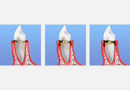 歯周病の場合
