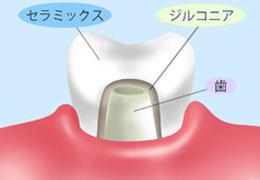 ジルコニアクラウン