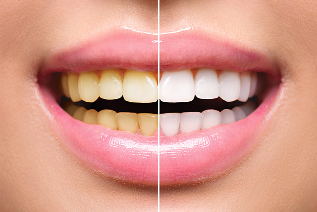 ホワイトニング｜武蔵小金井駅徒歩2分の歯医者・歯科「クオーレ歯科クリニック」