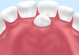 過剰歯の抜歯