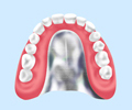 自費診療の入れ歯