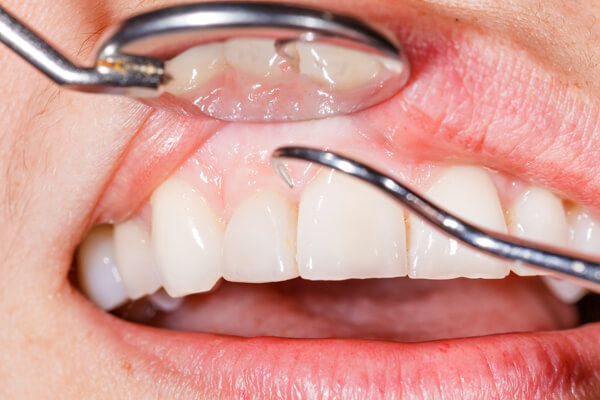 日本人が歯を失う原因第1位のお口のトラブル～歯周病治療～