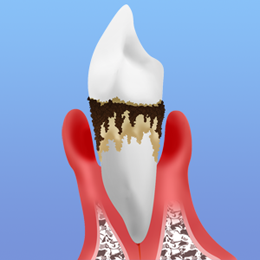 歯周病とは