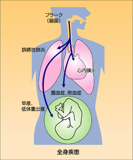 全身疾患と歯周病の関係