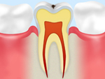 CO　初期の虫歯
