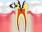 C3　神経に達した虫歯