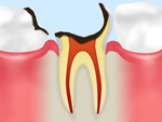 C4　歯根に達した虫歯